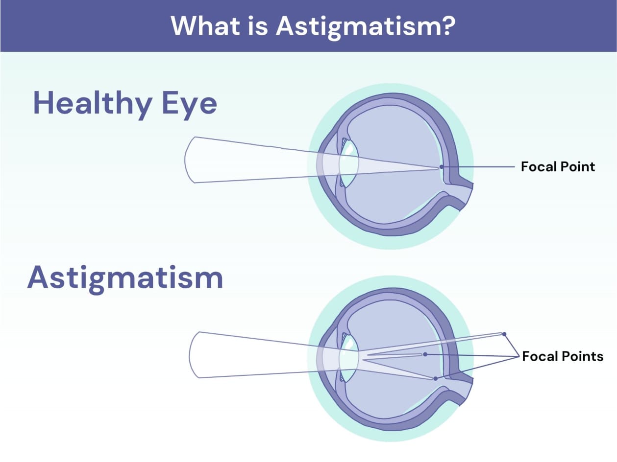 double vision astigmatism