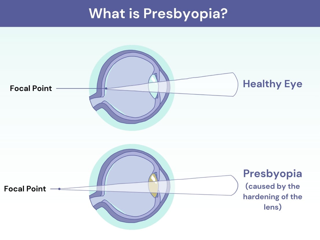 Diagram of a healthy eye and an eye with presbyopia caused by a hardening of the len